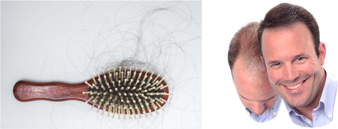 Hair Loss Treatments & Hair Transplant - Dermmatch Hair Loss Concealer Medium Brown (1252x438), Png Download