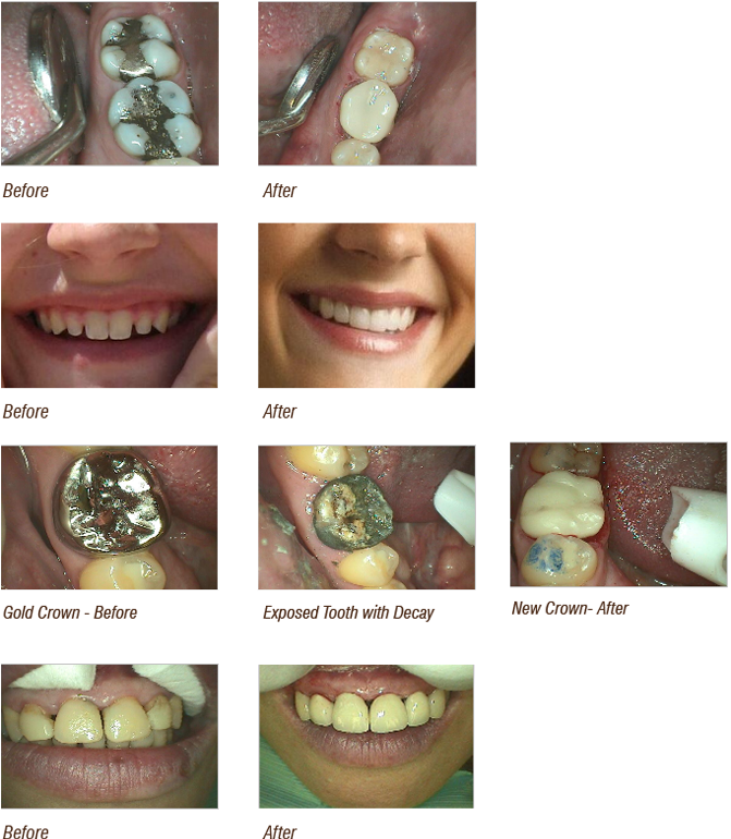 Before And After Cosmetic Dentistry Image - Castle Valley Dental (675x782), Png Download