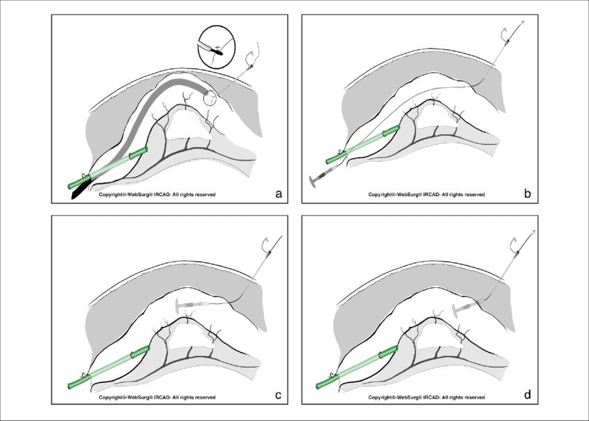 Percutaneous Colonic Anvil Control A, Once The Correct - Large Intestine (850x608), Png Download