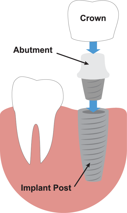 Dental Implants Illustration - Dental Implant (496x830), Png Download