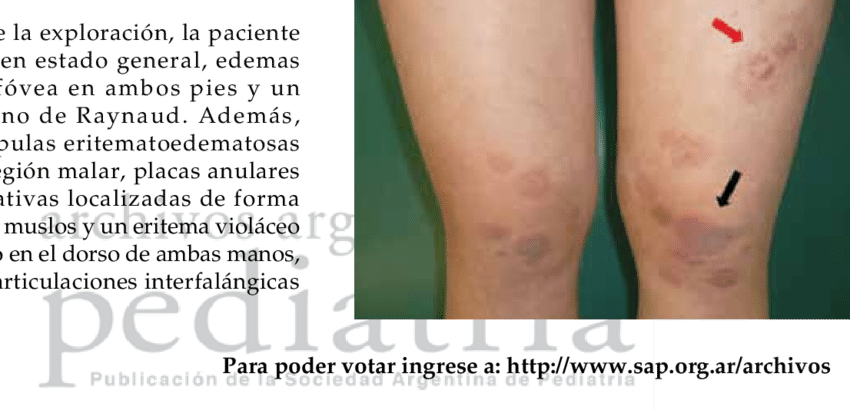 Placas Eritematosas, Violáceas Y Ligeramente Descamativas - Erythema (850x410), Png Download
