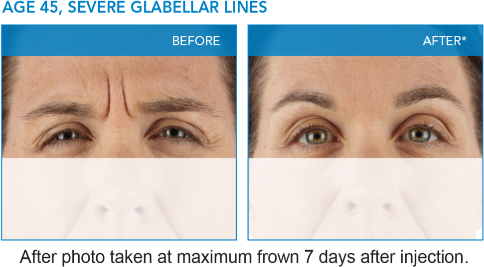 Xeomin® Results - 45u Dysport In Glabella (1024x574), Png Download