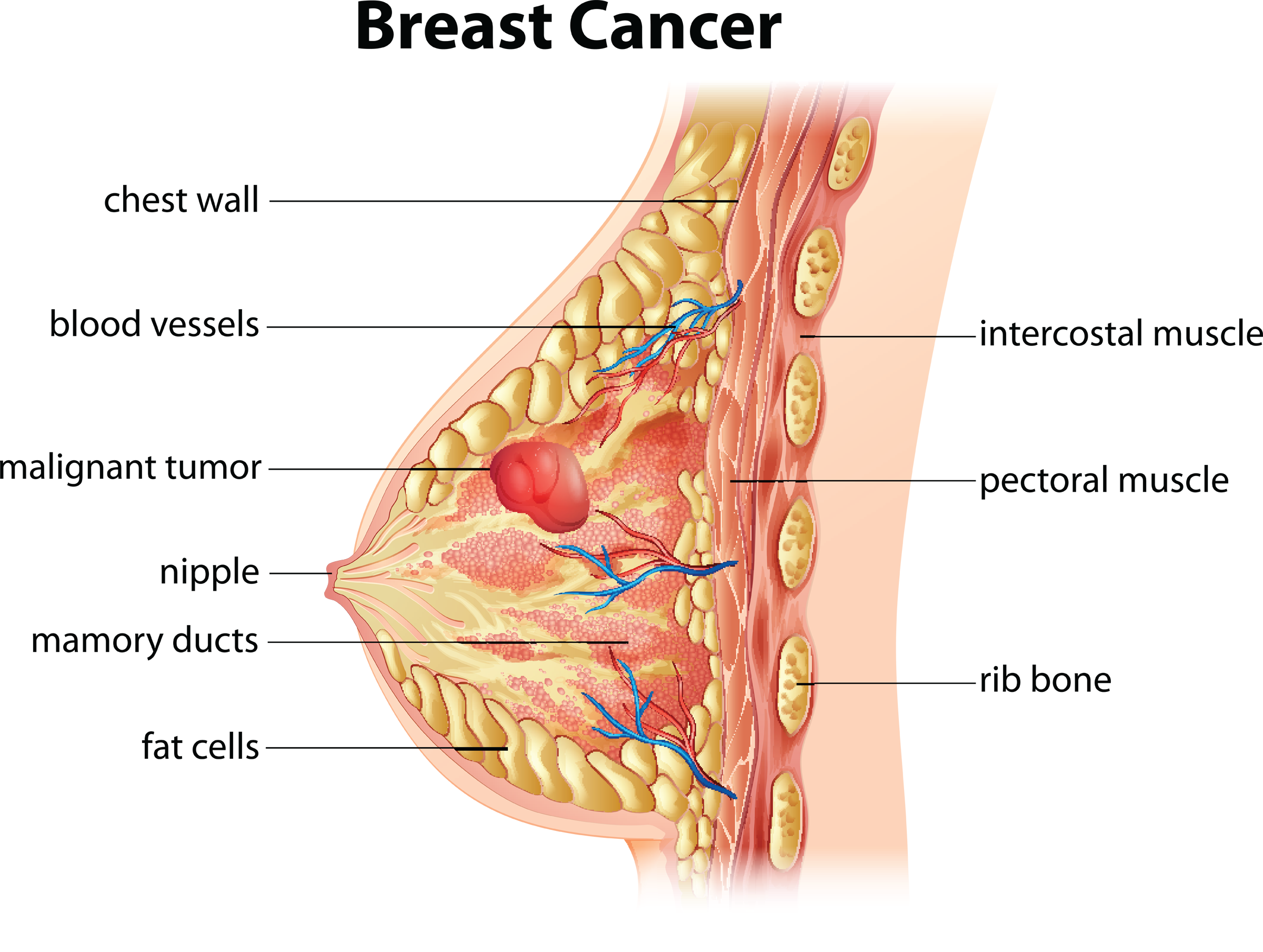 Breast Cancer Pic Clipart - Breast Cancer (2400x1808), Png Download