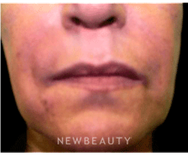 Dr Marina Peredo Radiesse B - Close-up (367x441), Png Download