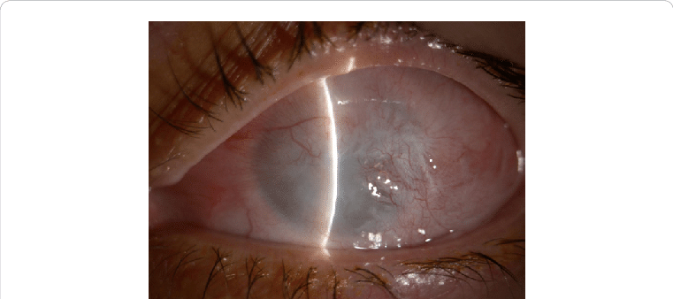 Third Degree Alkali Chemical Burn Os , 24 Months After - Chemical Burn (761x338), Png Download