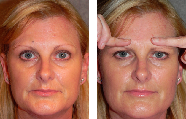 When The Brows - Botox Brow (675x435), Png Download