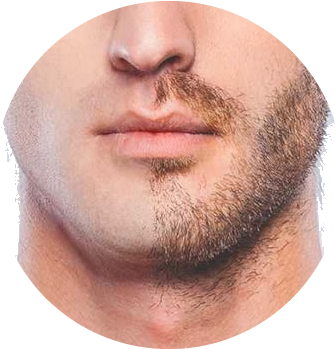 Beard And Mustache Transplantation - Outad Professional Men Liquid Beard Growth Pen Beard (360x352), Png Download