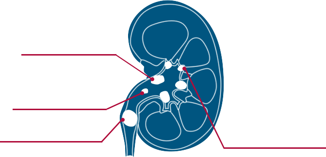 Types Of Kidney Stones - Graphic Design (672x325), Png Download