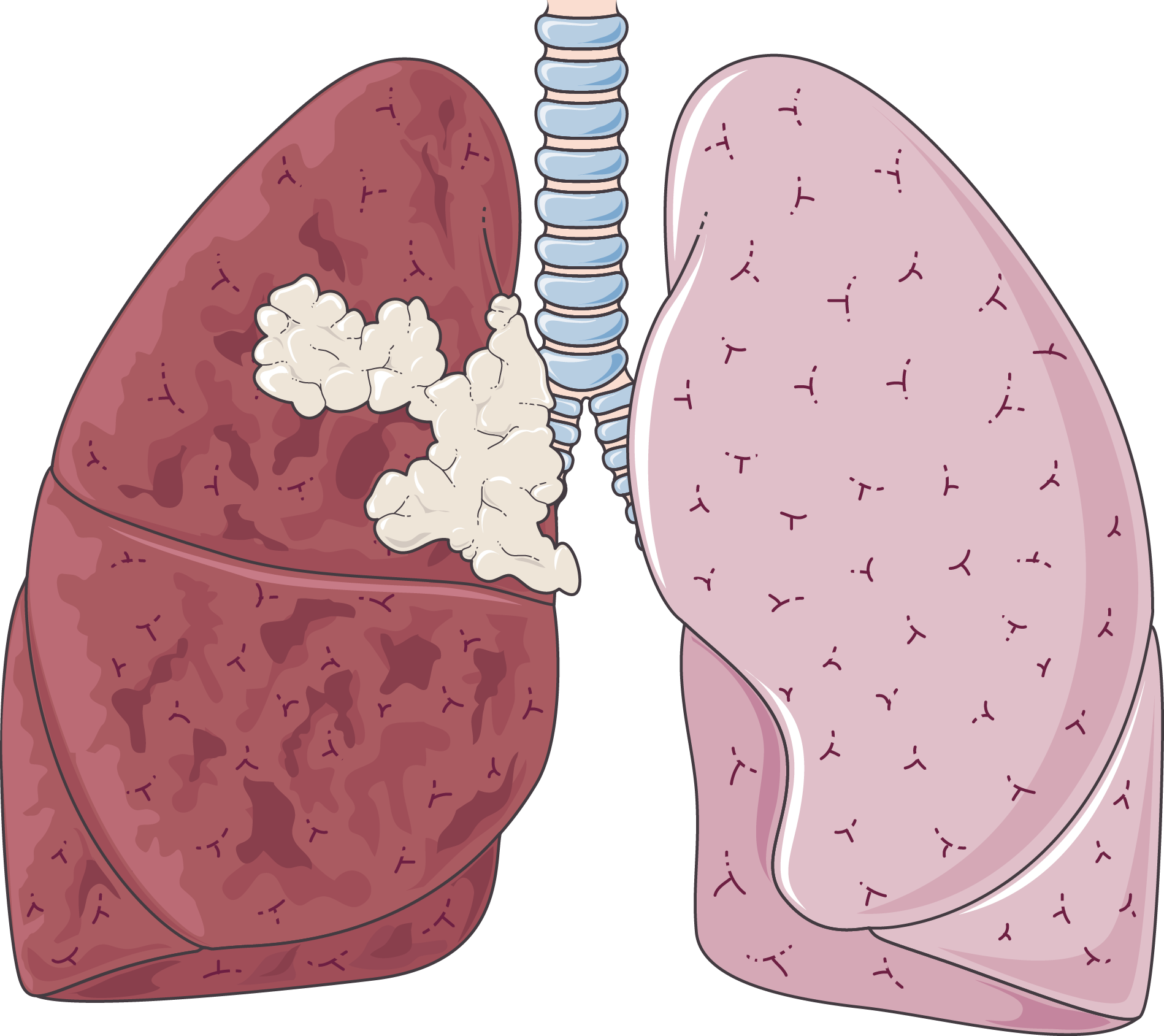 Clipart Library Clipart Lungs - Milo Yiannopoulos Twitter Roasts (1898x1689), Png Download