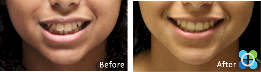 2 Orthodontique Before After Braces - Dental Braces (886x244), Png Download