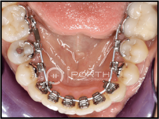 Sammamish Lingual Braces - Lingual Braces (606x500), Png Download