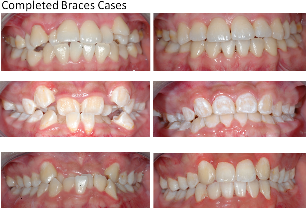 Dental Braces (1025x706), Png Download