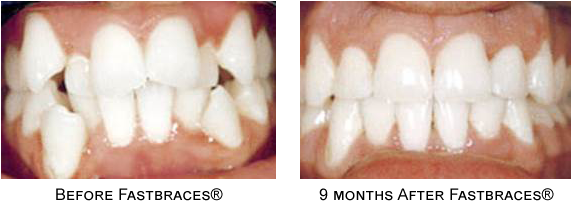 General Orthodontic Information - Fastbraces Nz (570x220), Png Download