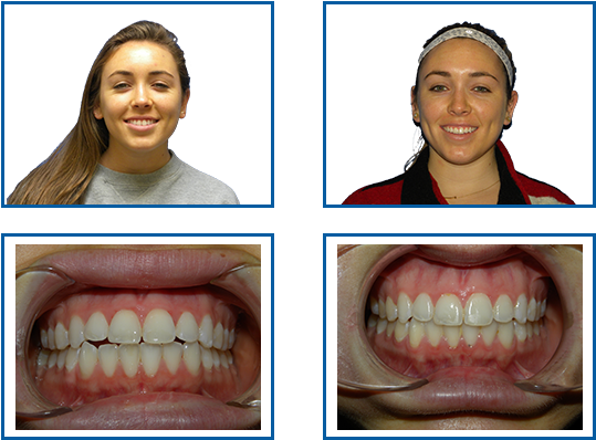 Before And After - Overjet (600x413), Png Download