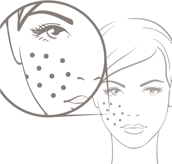 Symetrie Acne - Acne (600x600), Png Download