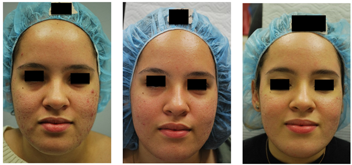 Acne, Acne Scarring And Pores Before , 1 Month Post - Mask (903x332), Png Download
