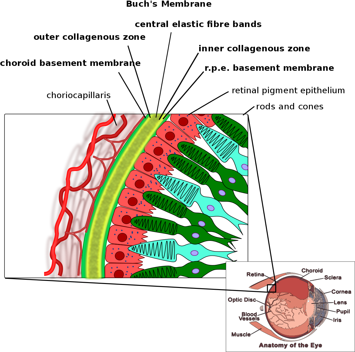 Angioid Streaks Bruch Membrane (1200x1188), Png Download