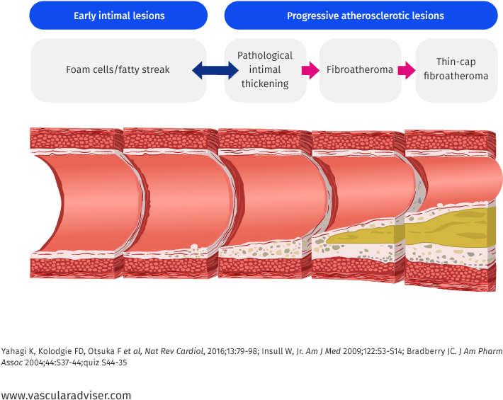 Atherosclerotic Lesion Development - Lesion (783x655), Png Download