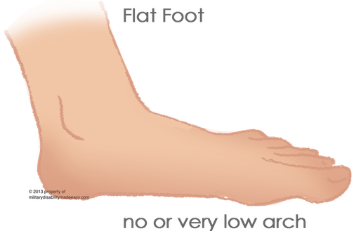 Flat Foot 1 - Flat Foot Disease (504x329), Png Download