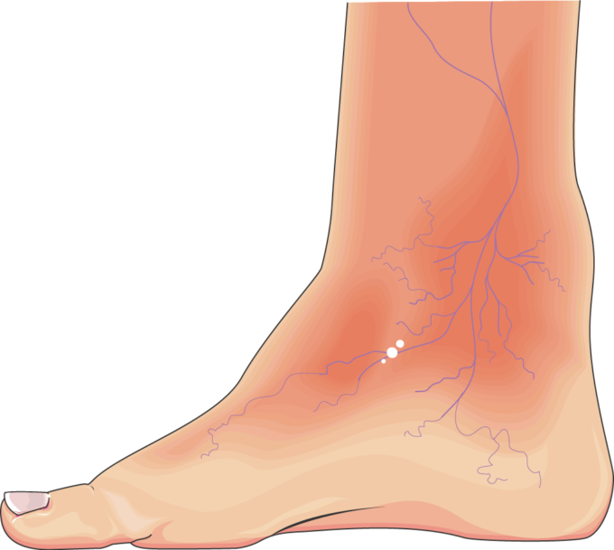 Diabetic Foot (680x609), Png Download