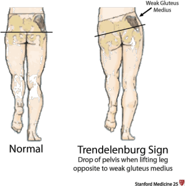 Hip Girdle Muscles Are Responsible For Keeping The - Trendelenburg Sign (620x618), Png Download