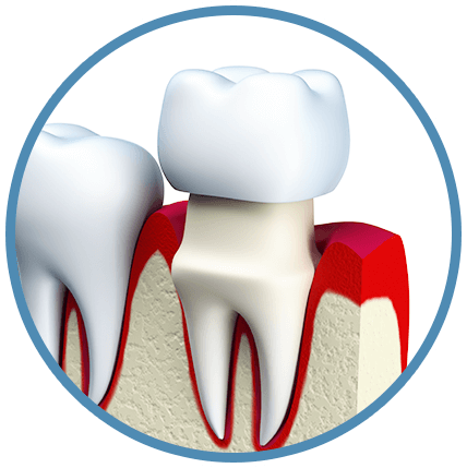 Dental Crowns - Tooth Porcelain Figure Png (428x429), Png Download