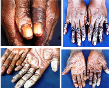 Burning Skin And Detachments From Contacts With Cashew - Cashew Nut Burn (605x290), Png Download
