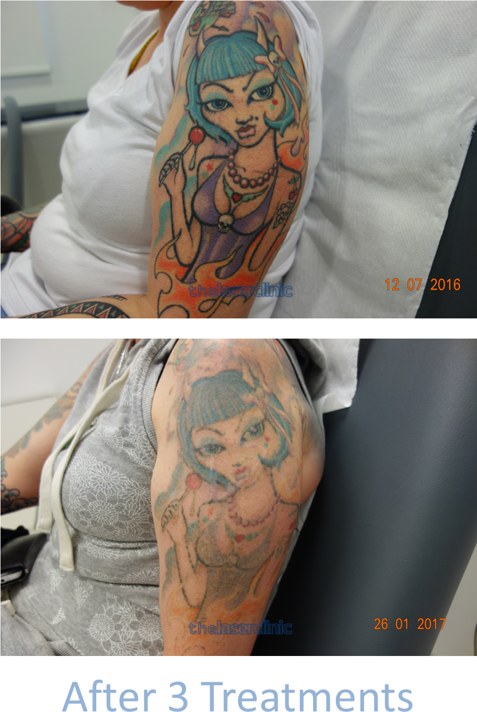 Fading This Brightly Coloured Tattoo Required Only - Tattoo Laser Colour Sleeve (1012x1488), Png Download