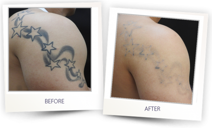 Pre Treatment - Clearlift Tattoo Removal (674x413), Png Download