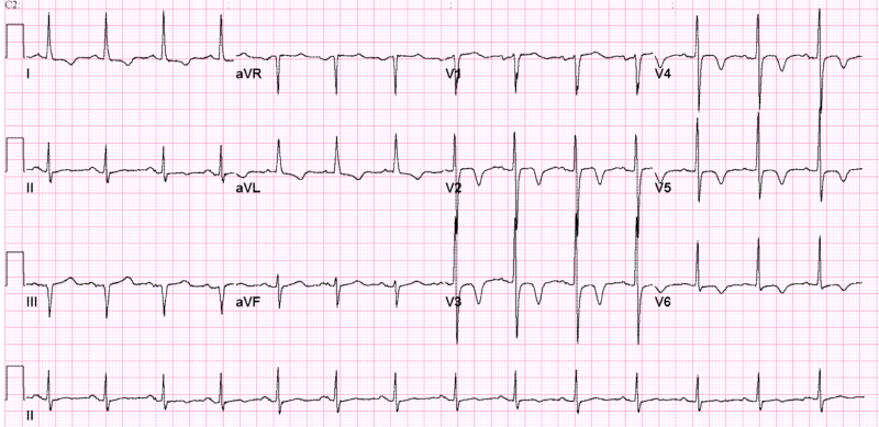 Cerebral T Waves - Electrocardiography (800x389), Png Download