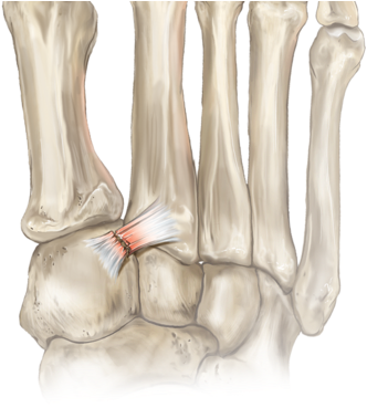 The Lisfranc Ligament Is A Strong Ligament In The Midfoot - Lesão De Turco Pé (400x370), Png Download