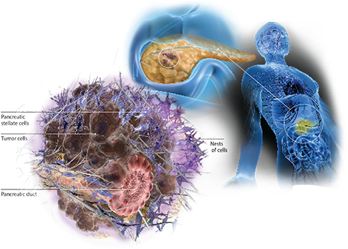 Pancreatic Cancer Illustration - Pancreatic Cancer (550x350), Png Download