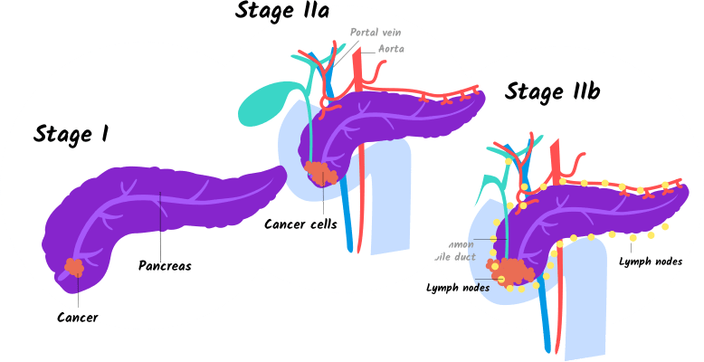 Illustration Of Stage I And Stage Iia And Iib Pancreatic - Stage 1 Stage 2 Pancreatic Cancer (778x400), Png Download