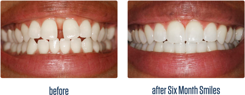 Gallery-11 - Before And After Six Month Smiles (1000x434), Png Download