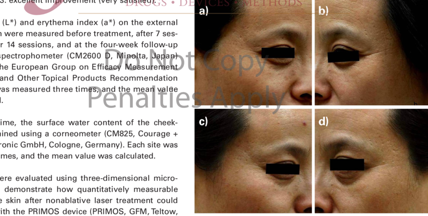 A 50 Year Old Woman Before The Treatment (c,d) And - Close-up (850x429), Png Download