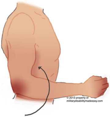 Upper Nerve 29 - Damage Of Musculocutaneous Nerve (360x383), Png Download