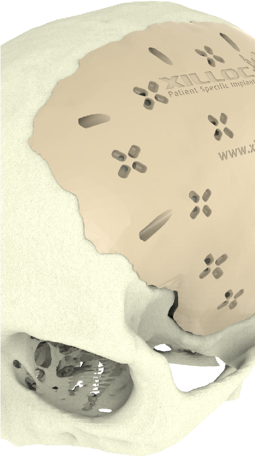 Cranial Implant - Implant (500x1000), Png Download