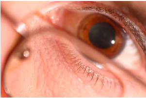 Eyes Pupil Dilation - Mydriasis (600x212), Png Download