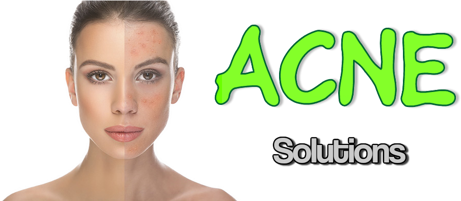 Richfeel Anti Acne Soap With Calendula Extracts (pack (898x402), Png Download