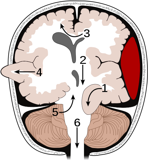Brain Herniation Types - Types Of Brain Herniation (500x543), Png Download