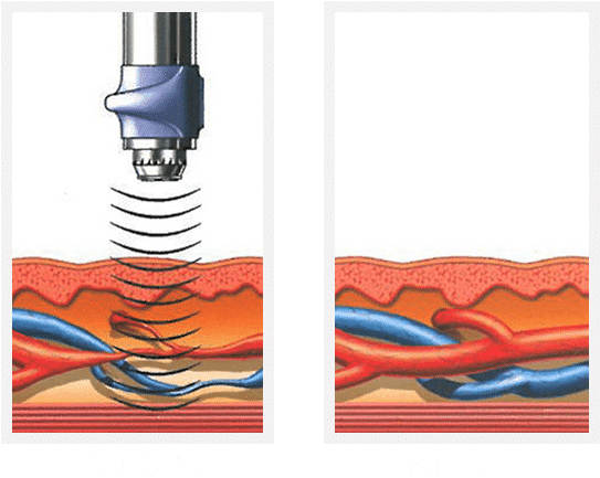 Gainswave For Erectile Dysfunction - Gainswave Before And After (548x456), Png Download