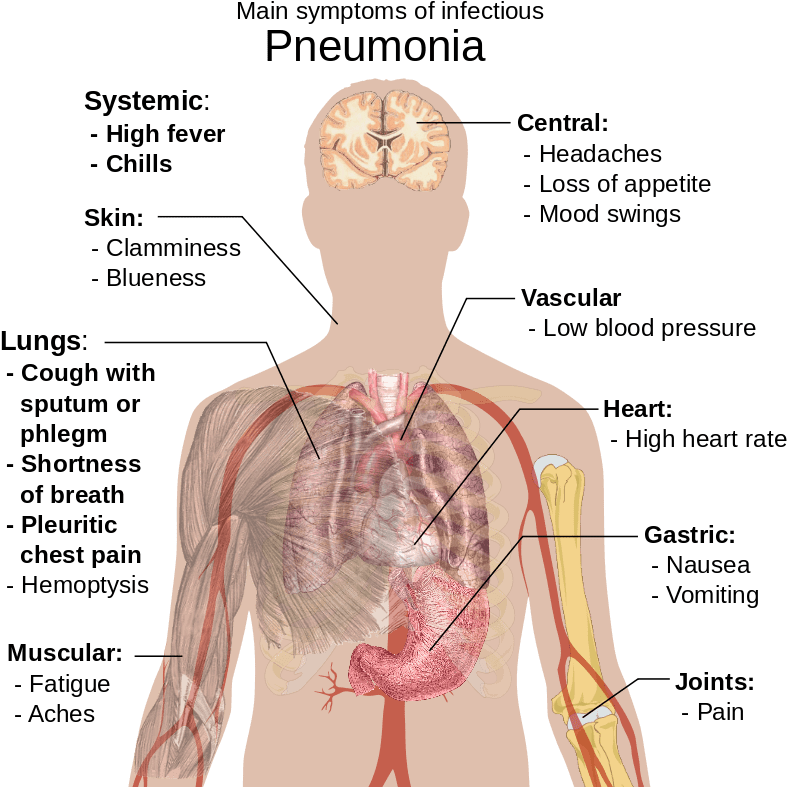 800px-symptoms Of Pneumonia - Pneumonia Sign And Symptom (800x792), Png Download