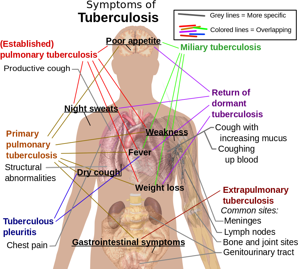 “symptoms Of Tuberculosis - Respiratory System Tuberculosis (1015x900), Png Download