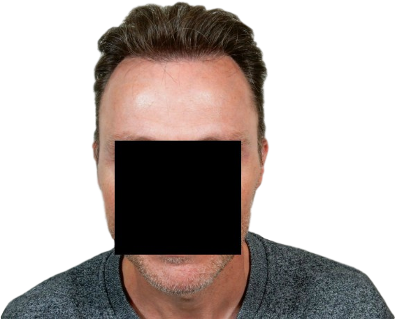 Fue Hair Transplantation - Smartphone (642x456), Png Download