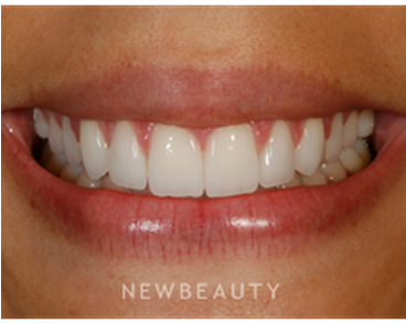 Dr Patrick Broome Gum Lift B - Gum Lift (367x441), Png Download