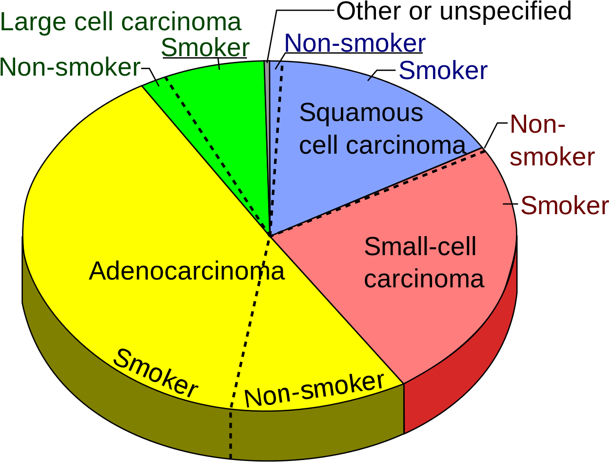 Types Non Small Cell Lung Cancer - Most Common Lung Cancer (1280x977), Png Download