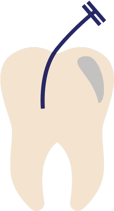 Endodontist Jacksonville Fl - Endodontics (936x845), Png Download