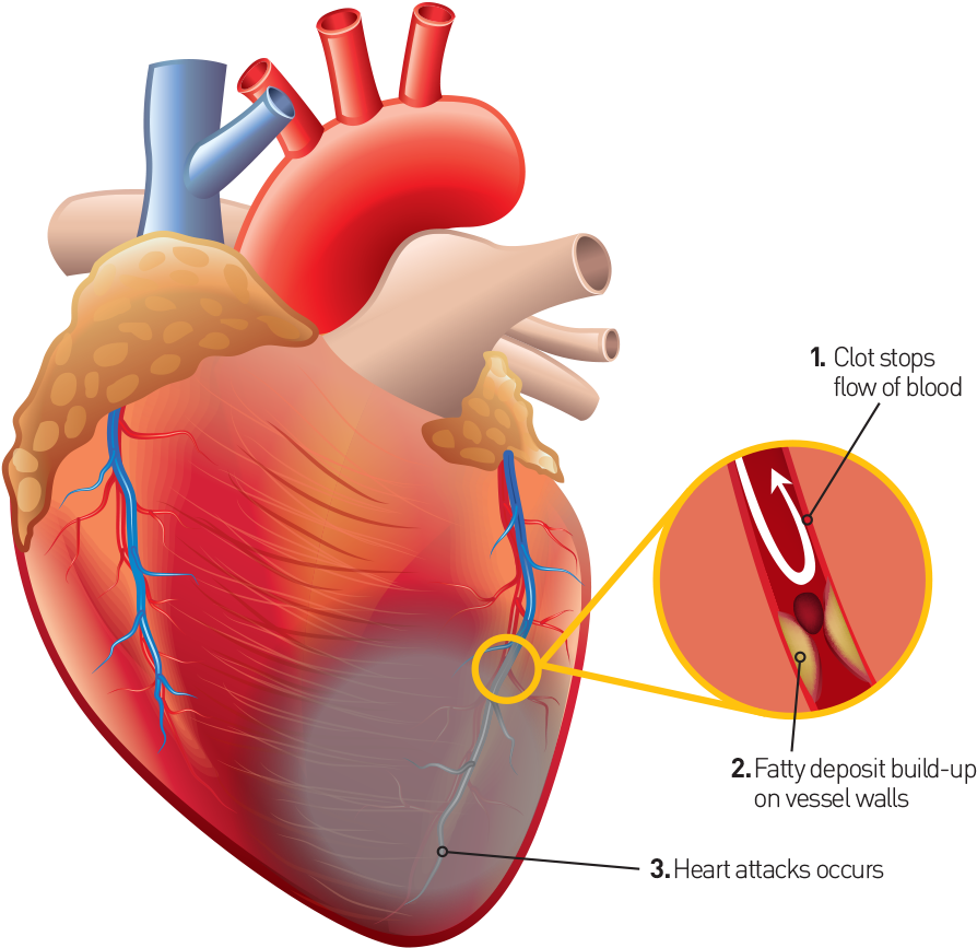 If The Oxygen Supply Is Reduced In The Blocked Artery - Imagens De Coração Humano (967x937), Png Download