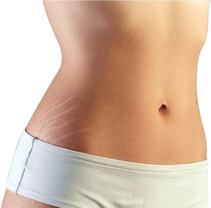 Stretch Marks (912x707), Png Download