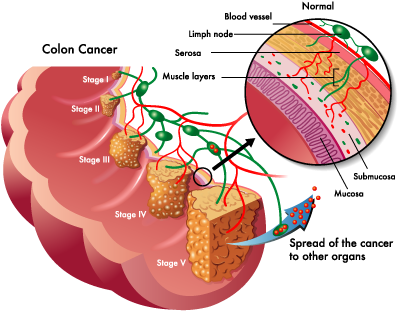 Approximately 150,000 New Cases Of Colorectal Cancer - Colon Cancer Stages (421x333), Png Download